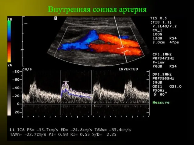 Внутренняя сонная артерия