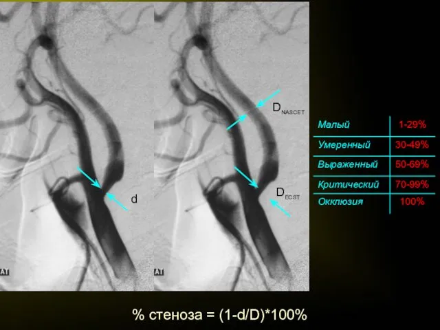 % стеноза = (1-d/D)*100%