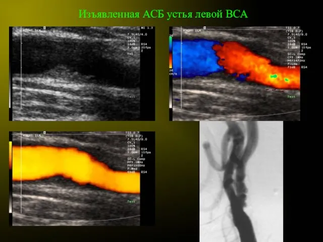 Изъявленная АСБ устья левой ВСА