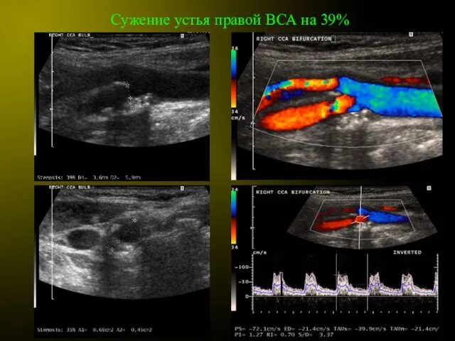 Сужение устья правой ВСА на 39%