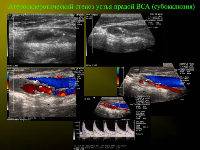 Атеросклеротический стеноз устья правой ВСА (субокклюзия)