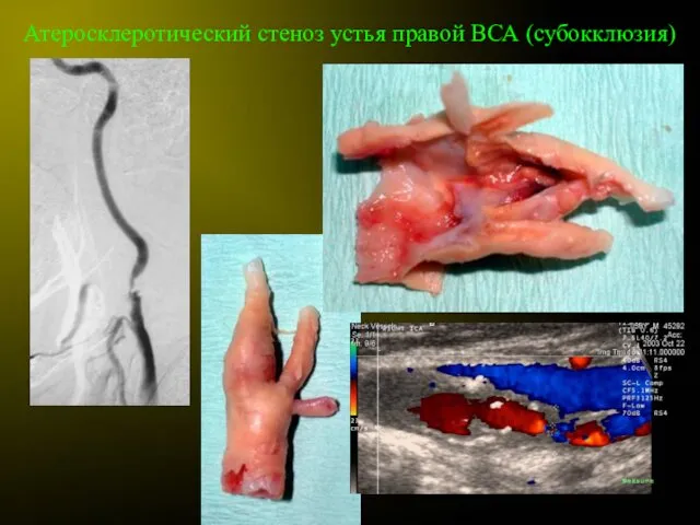 Атеросклеротический стеноз устья правой ВСА (субокклюзия)