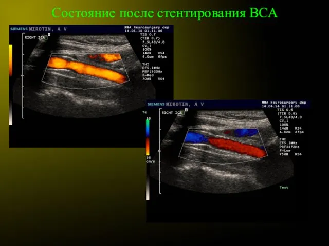 Состояние после стентирования ВСА