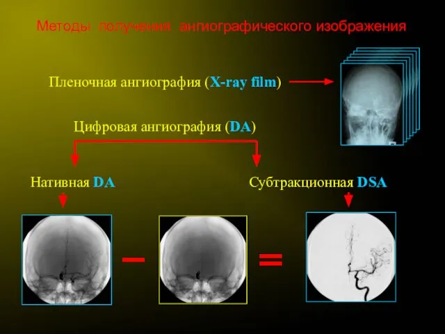 Методы получения ангиографического изображения Пленочная ангиография (X-ray film) Цифровая ангиография (DA) Нативная DA Субтракционная DSA