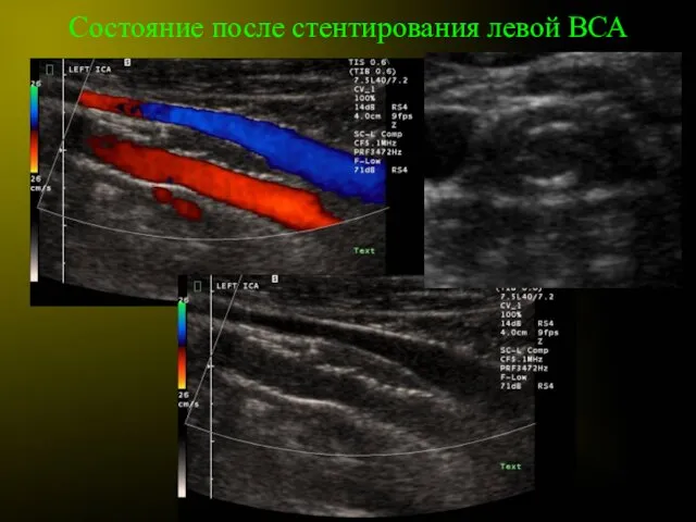 Состояние после стентирования левой ВСА