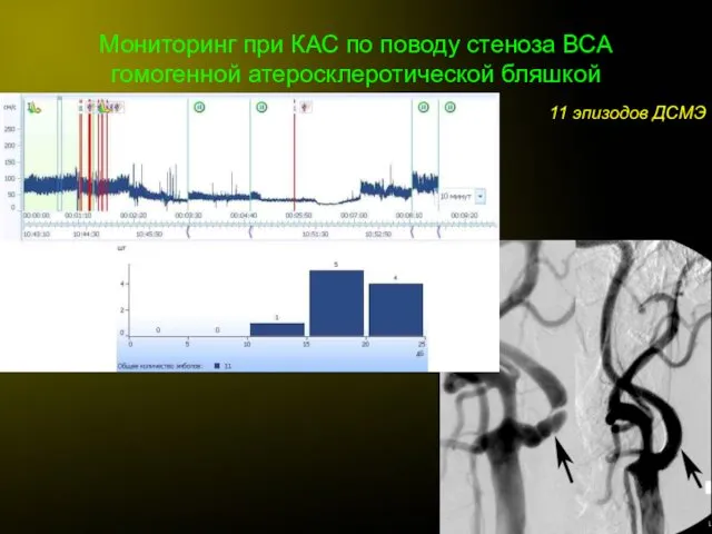 Мониторинг при КАС по поводу стеноза ВСА гомогенной атеросклеротической бляшкой 11 эпизодов ДСМЭ