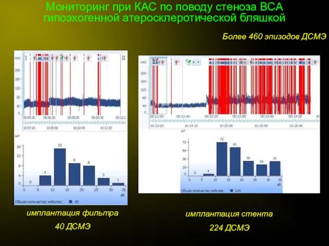 Мониторинг при КАС по поводу стеноза ВСА гипоэхогенной атеросклеротической бляшкой имплантация