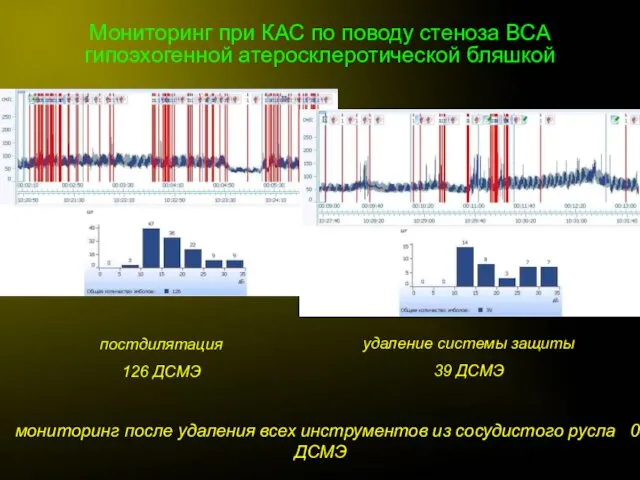 Мониторинг при КАС по поводу стеноза ВСА гипоэхогенной атеросклеротической бляшкой постдилятация