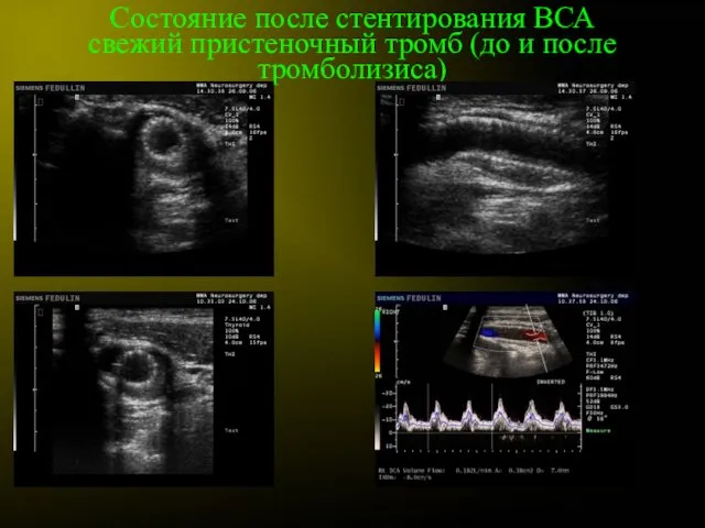 Состояние после стентирования ВСА свежий пристеночный тромб (до и после тромболизиса)