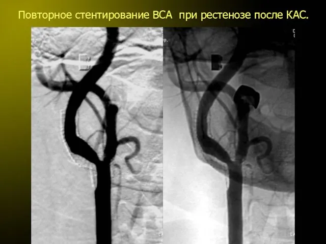 Повторное стентирование ВСА при рестенозе после КАС.