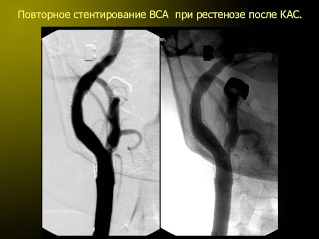 Повторное стентирование ВСА при рестенозе после КАС.