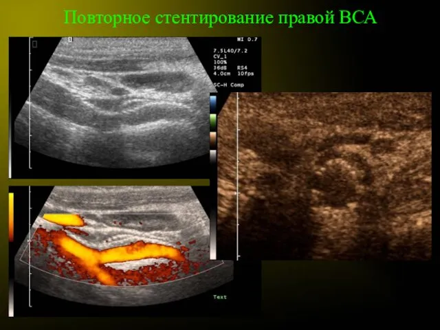 Повторное стентирование правой ВСА