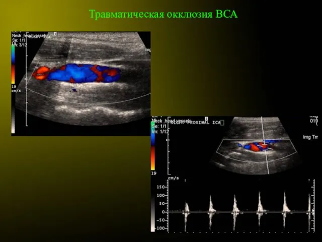 Травматическая окклюзия ВСА