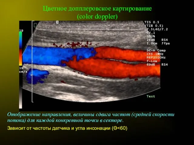 Цветное допплеровское картирование (color doppler) Отображение направления, величины сдвига частот (средней