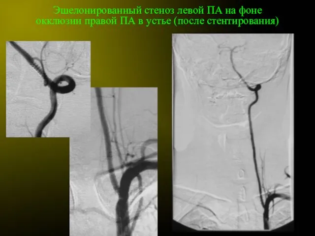 Эшелонированный стеноз левой ПА на фоне окклюзии правой ПА в устье (после стентирования)