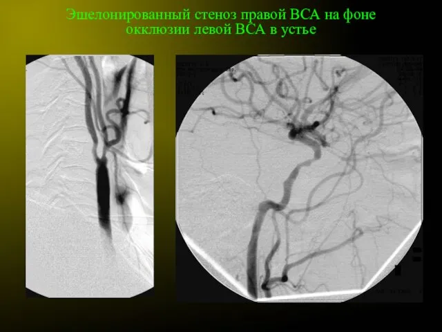 Эшелонированный стеноз правой ВСА на фоне окклюзии левой ВСА в устье