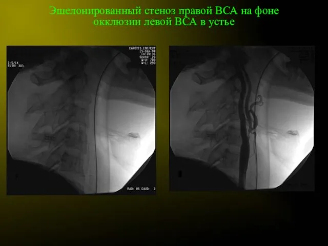 Эшелонированный стеноз правой ВСА на фоне окклюзии левой ВСА в устье