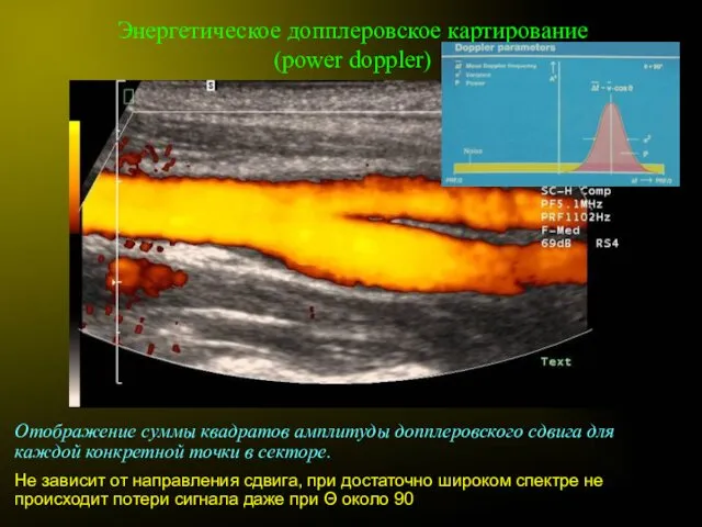 Энергетическое допплеровское картирование (power doppler) Отображение суммы квадратов амплитуды допплеровского сдвига