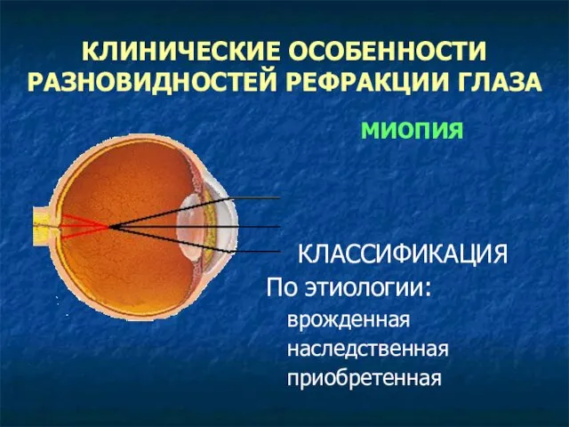 КЛИНИЧЕСКИЕ ОСОБЕННОСТИ РАЗНОВИДНОСТЕЙ РЕФРАКЦИИ ГЛАЗА МИОПИЯ КЛАССИФИКАЦИЯ По этиологии: врожденная наследственная приобретенная