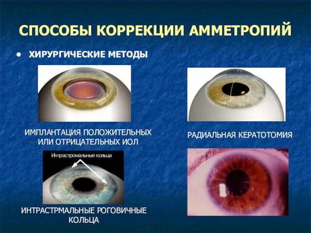 СПОСОБЫ КОРРЕКЦИИ АММЕТРОПИЙ ХИРУРГИЧЕСКИЕ МЕТОДЫ ИМПЛАНТАЦИЯ ПОЛОЖИТЕЛЬНЫХ ИЛИ ОТРИЦАТЕЛЬНЫХ ИОЛ РАДИАЛЬНАЯ КЕРАТОТОМИЯ ИНТРАСТРМАЛЬНЫЕ РОГОВИЧНЫЕ КОЛЬЦА