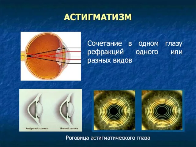 АСТИГМАТИЗМ Сочетание в одном глазу рефракций одного или разных видов Роговица астигматического глаза