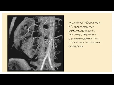 Мультиспиральная КТ, трехмерная реконструкция. Множественный сегментарный тип строения почечных артерий.