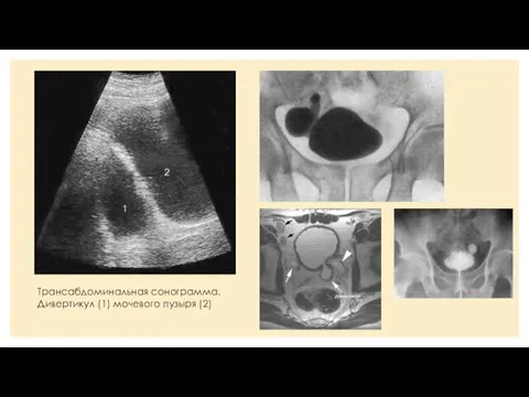 Трансабдоминальная сонограмма. Дивертикул (1) мочевого пузыря (2)