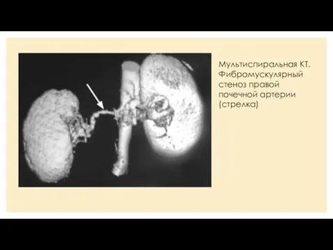 Мультиспиральная КТ. Фибромускулярный стеноз правой почечной артерии (стрелка)