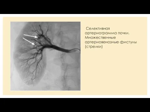 Селективная артериограмма почки. Множественные артериовенозные фистулы (стрелки)