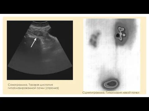 Сонограмма. Тазовая дистопия гипоплазированной почки (стрелка) Сцинтиграмма. Гипоплазия левой почки