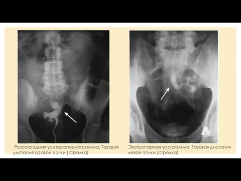 Ретроградная уретеропиелограмма. Тазовая дистопия правой почки (стрелка) Экскреторная урограмма. Тазовая дистопия левой почки (стрелка)