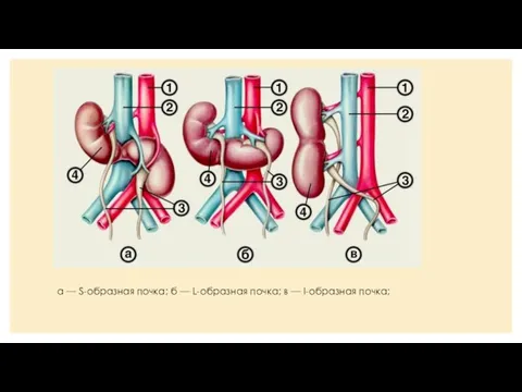 а — S-образная почка; б — L-образная почка; в — I-образная почка;
