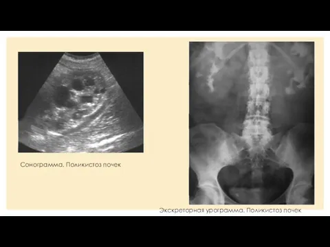 Сонограмма. Поликистоз почек Экскреторная урограмма. Поликистоз почек