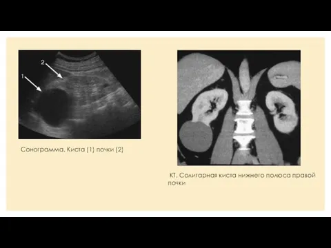 Сонограмма. Киста (1) почки (2) КТ. Солитарная киста нижнего полюса правой почки
