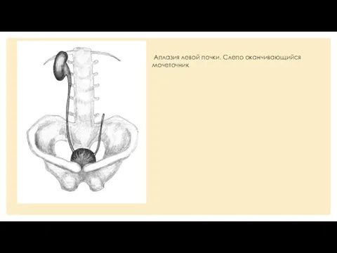 Аплазия левой почки. Слепо оканчивающийся мочеточник