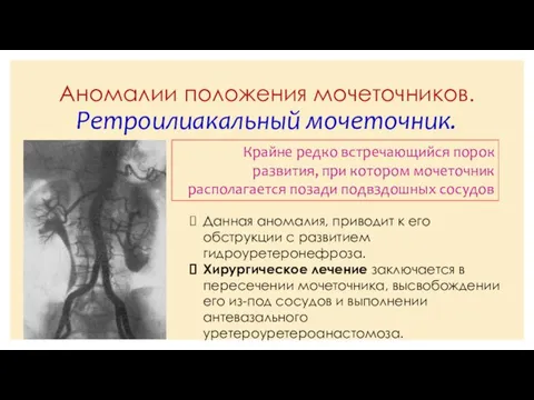 Аномалии положения мочеточников. Ретроилиакальный мочеточник. Крайне редко встречающийся порок развития, при