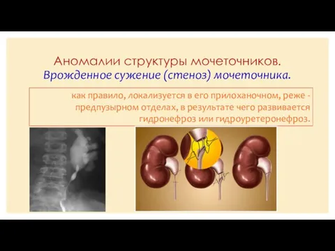 Аномалии структуры мочеточников. Врожденное сужение (стеноз) мочеточника. как правило, локализуется в