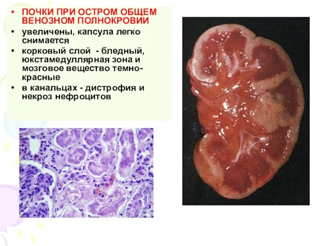 ПОЧКИ ПРИ ОСТРОМ ОБЩЕМ ВЕНОЗНОМ ПОЛНОКРОВИИ увеличены, капсула легко снимается корковый