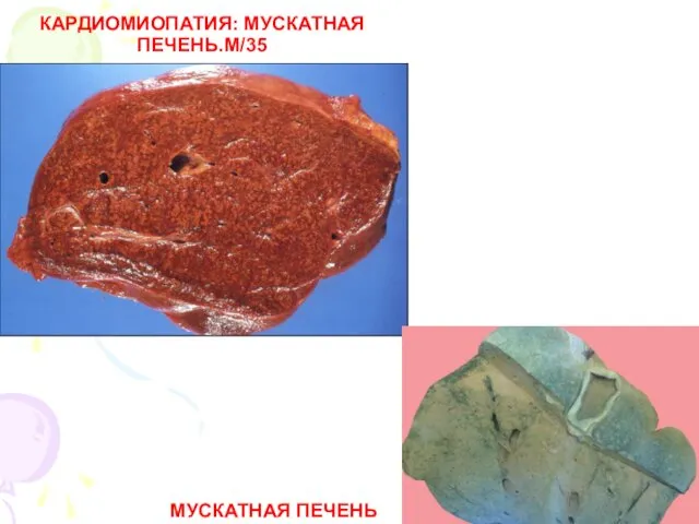 КАРДИОМИОПАТИЯ: МУСКАТНАЯ ПЕЧЕНЬ.М/35 МУСКАТНАЯ ПЕЧЕНЬ