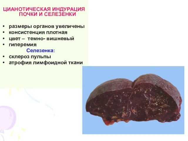 ЦИАНОТИЧЕСКАЯ ИНДУРАЦИЯ ПОЧКИ И СЕЛЕЗЕНКИ размеры органов увеличены консистенция плотная цвет