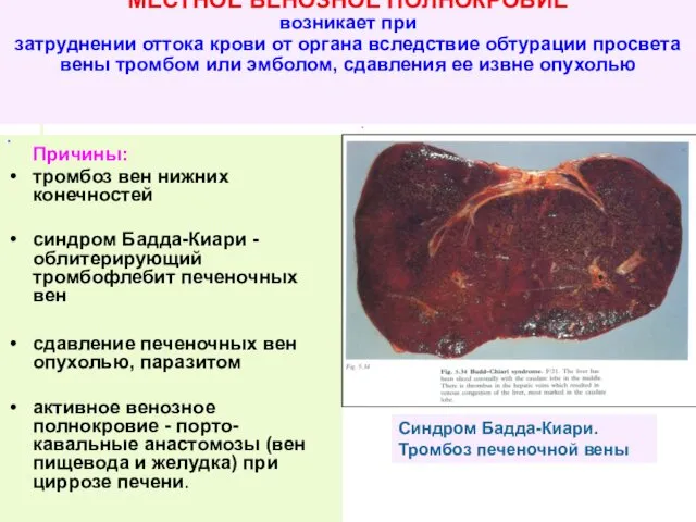 МЕСТНОЕ ВЕНОЗНОЕ ПОЛНОКРОВИЕ возникает при затруднении оттока крови от органа вследствие