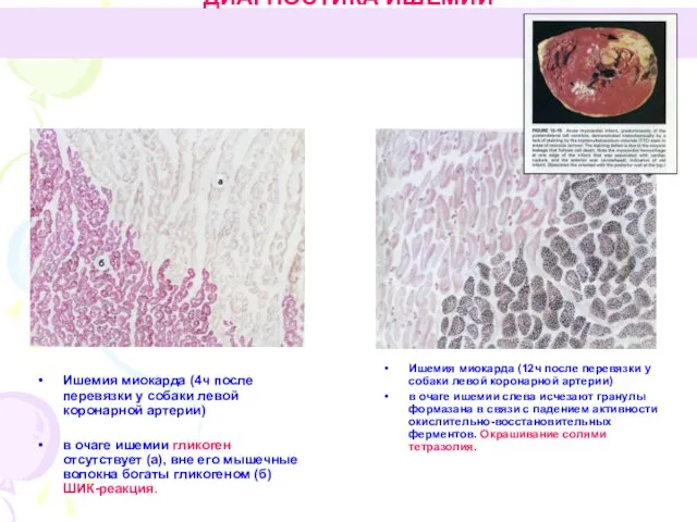 ДИАГНОСТИКА ИШЕМИИ Ишемия миокарда (4ч после перевязки у собаки левой коронарной