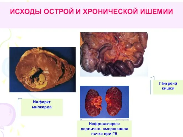 ИСХОДЫ ОСТРОЙ И ХРОНИЧЕСКОЙ ИШЕМИИ Инфаркт миокарда Гангрена кишки Нефросклероз: первично- сморщенная почка при ГБ