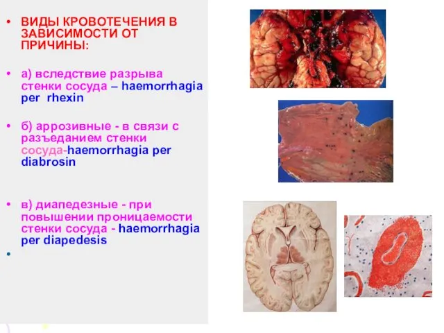 ВИДЫ КРОВОТЕЧЕНИЯ В ЗАВИСИМОСТИ ОТ ПРИЧИНЫ: а) вследствие разрыва стенки сосуда