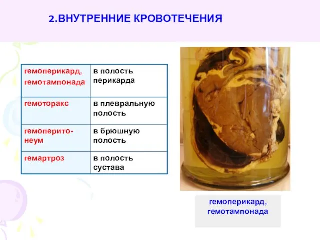 2.ВНУТРЕННИЕ КРОВОТЕЧЕНИЯ гемоперикард, гемотампонада