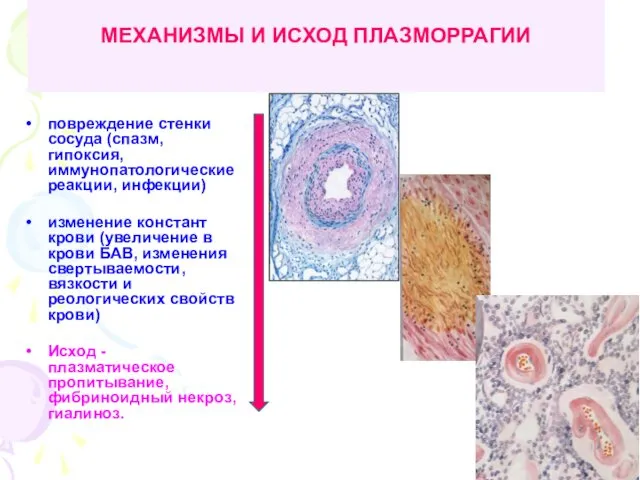 МЕХАНИЗМЫ И ИСХОД ПЛАЗМОРРАГИИ повреждение стенки сосуда (спазм, гипоксия, иммунопатологические реакции,