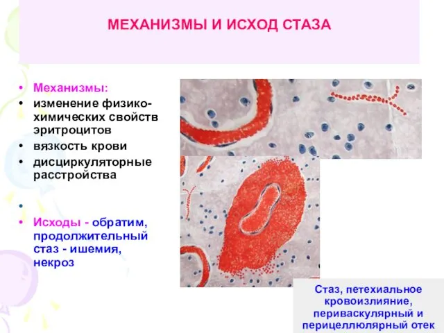 МЕХАНИЗМЫ И ИСХОД СТАЗА Механизмы: изменение физико-химических свойств эритроцитов вязкость крови