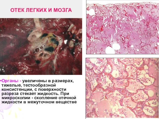 ОТЕК ЛЕГКИХ И МОЗГА Органы - увеличены в размерах, тяжелые, тестообразной