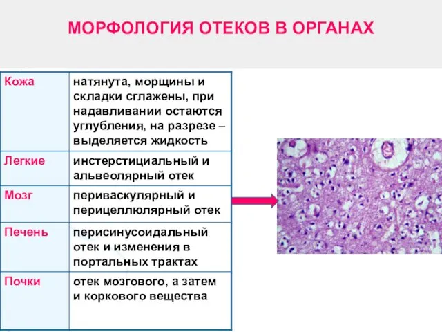 МОРФОЛОГИЯ ОТЕКОВ В ОРГАНАХ