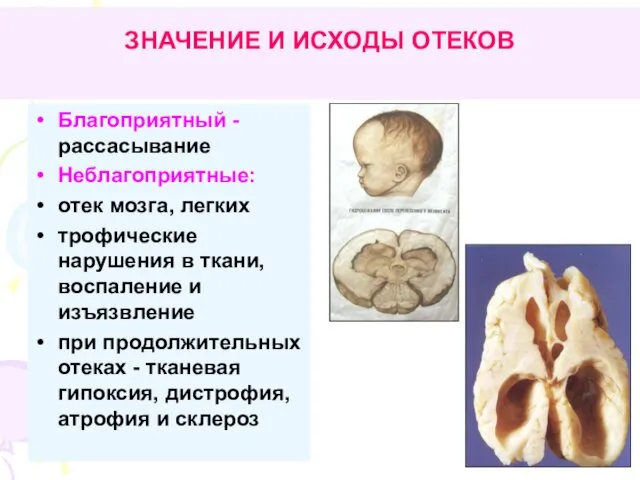 ЗНАЧЕНИЕ И ИСХОДЫ ОТЕКОВ Благоприятный - рассасывание Неблагоприятные: отек мозга, легких